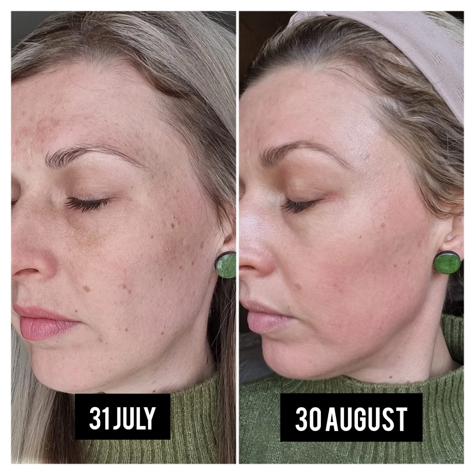 Cosmelan – Pigmentation Correction